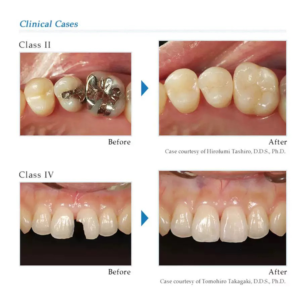 Tokuyama PALFIQUE LX5 Dental C - Lighting Jockey 리뷰 및 가격